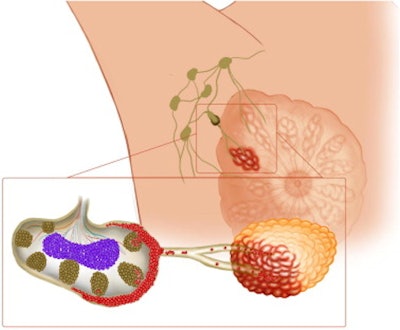 Demonstration of tumoral cells invading the axillary cortex. Images courtesy of Dr. Seda Aladag Kurt and EJR.