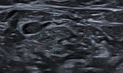 A 58-year-old woman diagnosed as having invasive ductal carcinoma with neuroendocrine differentiation. The lymph node shows asymmetrical cortical enlargement at the closer side to the breast, with remarkable focal abnormal vascularization on SMI (superb microvascular imaging).