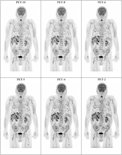 Example of maximum intensity projection (MIP) F-18 FDG-PET images of a 74-year-old man with stage IV cutaneous melanoma planned for treatment with immune checkpoint inhibitors. Presented are the PET-10, PET-8, PET-6, PET-5, PET-4, and PET-2 acquisitions. All acquisitions clearly demonstrate disseminated F-18 FDG-avid metastatic disease. Image and caption courtesy of the European Journal of Nuclear Medicine and Molecular Imaging.