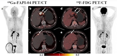 A 66-year-old man was histopathologically diagnosed with gastric antrum adenocarcinoma with perigastric lymph node metastases, and a false-positive uptake of Ga-68 FAPI-04 in the liver was proven to be a fibrotic nodule with calcified schistosome egg deposition without heterotypic findings. (a-c) Ga-68 FAPI-04 PET/CT imaging. Maximal intensity projection (MIP) image of Ga-68 FAPI-04 PET (a), clear recognition of gastric cancer lesion (solid arrow in b) and metastatic lymph node (dotted arrow in b), fibrotic nodule with calcified schistosome egg deposition mimicking liver metastasis (c). (d-f) F-18-FDG-PET/CT imaging. MIP image of F-18 FDG-PET (f), lower F-18 FDG-uptake in gastric cancer lesion (solid arrow in d) and the metastatic lymph node (dotted arrow in d) compared with Ga-68 FAPI, liver lesion showed negative uptake (e).