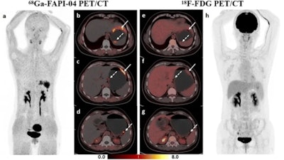 A 44-year-old woman was histopathologically diagnosed with poorly cohesive carcinoma (with partial signet ring cell carcinoma) in the greater curvature of the gastric body and posterior wall of the gastric fundus and had perigastric lymph node metastases. (a-d) Ga-68 FAPI-04 PET/CT imaging. Maximal intensity projection (MIP) image of Ga-68 FAPI-04 PET (a), clear identification of gastric cancer lesions (solid arrow in b, c, and dotted arrow in b) and perigastric metastatic lymph nodes (dotted arrow in c, d). e-h: F-18 FDG-PET/CT imaging. MIP image of F-18 FDG-PET (h), the gastric lesion in the greater curvature of the gastric body (solid arrow in e, f) displayed diffuse mild uptake, the lesions in the posterior wall of the gastric fundus (dotted arrow in e) and perigastric metastatic lymph nodes (dotted arrow in f, g) showed negative uptake. All images courtesy of Ying Miao, Runhua Feng, Zhenggang Zhu, and Biao Li and European Radiology.