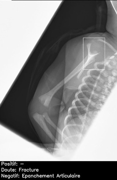Normal lateral scapular Y view of right shoulder in child, incorrectly interpreted by AI candidate as having proximal humeral fracture (dashed bounding box). This was a false-positive result, which was correctly identified as normal by all 26 radiologists. Note: épanchement articulaire = joint effusion.