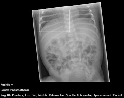 Normal pediatric abdominal radiograph interpreted by AI candidate as having right basal pneumothorax with dashed bounding box (false-positive result). This should have been identified as non-interpretable by AI. French translation: positif = positive; doute = doubt; épanchement pleural = pleural effusion; luxation = dislocation; négatif = negative; nodule pulmonaire = pulmonary nodule; opacité pulmonaire = pulmonary opacification.
