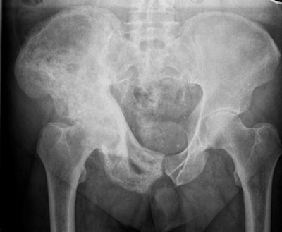 Abnormal adult pelvic radiograph shows increased sclerosis and expansion of right iliac bone in keeping with Paget's disease. This was correctly identified by almost all radiologists (96%) but interpreted as normal by AI candidate (false negative), given that this was not a pathology it was trained to identify. All clinical images courtesy of Dr. Susan Cheng Shelmerdine et al and BMJ.
