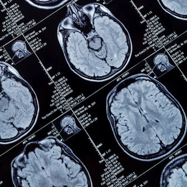 MR spectroscopy distinguishes recurrent brain tumors from necrosis ...