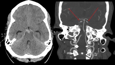 A 37-year-old woman who was a cocaine user presented with sudden onset headache and was found to have a left sixth cranial nerve palsy. CT shows subarachnoid hemorrhage with mild hydrocephalus. CT angiogram shows bilateral superior cerebellar artery aneurysms, probably mycotic (red arrows).
