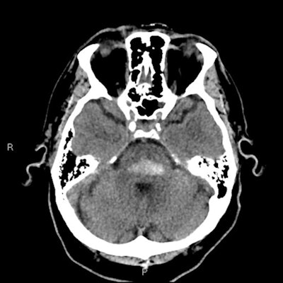 A 48-year-old 'ice' (crystal methamphetamine) user presented with sudden onset of right-sided weakness and slurred speech, having a blood pressure of 210/90 on presentation. CT shows an acute pontine hemorrhage.