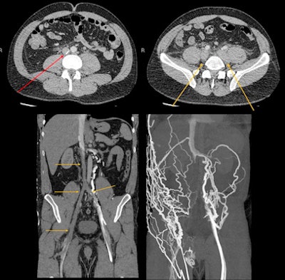 A 34-year-old man who was a weekend methamphetamine user presented with gross bilateral leg swelling. He injected into the groin so the needle marks would not show at work. A needle broke off and embolized into the inferior vena cava (IVC), where it became embedded in the wall (red arrow), causing extensive thrombosis of the IVC and both iliac and femoral veins (yellow arrows). Later there was extensive collateralization. All images courtesy of Dr. Sarah Constantine and Dr. Jim Buckley, presented at 2022 ASM of RANZCR.