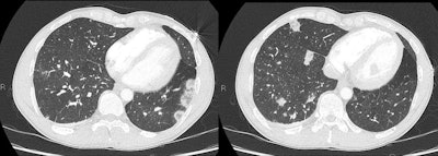 A 35-year-old man who was a regular heroin user presented with pleuritic chest pain and fever. A chest CT scan shows multiple bilateral lung nodules that are beginning to cavitate, consistent with septic emboli. He had cellulitis of his arm from injecting.