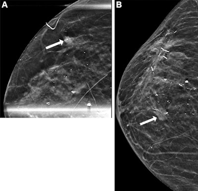 Mammography images show the timeline of diagnosis and surveillance screening for a 68-year-old woman with a history of benign excisional biopsy performed during breast cancer screening. (A) Diagnostic mammogram (synthetic mammography, craniocaudal view) shows new calcifications and an adjacent mass (arrow). Upon biopsy, an estrogen receptor-positive, progesterone receptor-positive, intermediate-grade DCIS is identified. At this time, the patient underwent lumpectomy and radiation therapy. (B) Surveillance mammogram (synthetic mammography, craniocaudal view) obtained three years after image A shows a new spiculated mass (arrow). Another biopsy revealed an estrogen receptor-positive, progesterone receptor-positive, human epidermal growth factor receptor 2-negative, intermediate-grade invasive ductal carcinoma. Images and caption courtesy of RSNA.
