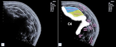 B-mode ultrasound imaging shows short rotator (yellow) and cervical multifidus (blue) muscles. Panoramic ultrasound imaging of posterior neck muscles shows short rotators (yellow) and cervical multifidus (blue). Images courtesy of Physica Medica under CC BY 4.0 International license.