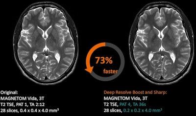 The software is available on the Magnetom Vida MRI scanner.