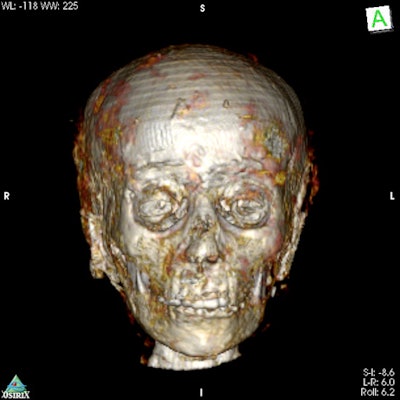 3D CT image shows oval face, with a small nose, a narrow chin, and partially open eyes.