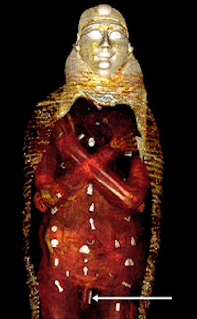 3D CT image of the front of the digitally unwrapped torso of mummy shows the crossed arms position and the amulets. The separately wrapped upper limbs are bent at the elbows and crossed in front of the chest. Amulets are seen arranged in three columns on the front surface of the torso. An amulet is placed beside the penis.