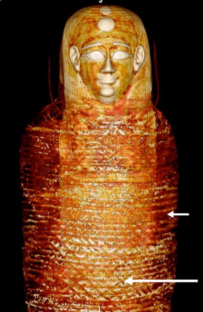 3D CT image of the front of the head and torso of mummy shows the head mask and the most outer bandages arranged transversely (short arrow) and diagonally in a criss-cross orientation (long arrow).
