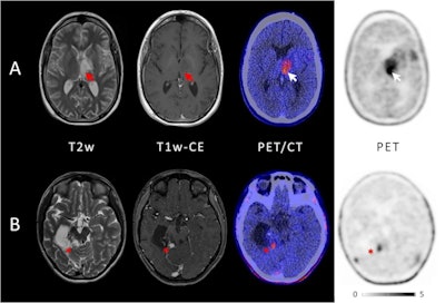 Example of two patients with concordant imaging results (A) and incremental diagnostic value of F-18 FET-PET (B). (A) Example of a patient with an anaplastic astrocytoma WHO grade III who was treated with combined radiochemotherapy prior to PET. Axial T2-weighted imaging and T1-weighted imaging with contrast enhancement depict the tumor in the left thalamus and insular region (red arrows); axial PET shows high uptake of F-18 FET in these regions (white arrows). Both MRI and PET correctly identified the tumor recurrence. (B) Example of a patient with a pilocytic astrocytoma who was treated with surgery and chemotherapy prior to PET. Axial T2-weighted imaging and T1-weighted imaging with contrast enhancement show cystic as well as contrast-enhancing lesions next to the surgical cavity consistent with both unspecific changes and tumor recurrence (red asterisk); in contrast, axial PET demonstrates focal high uptake of F-18 FET (white asterisk). Image courtesy of the European Journal of Nuclear Medicine and Molecular Imaging through CC BY 4.0.