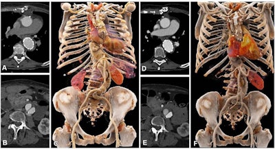 Comparison of image quality between EID CT with standard contrast media protocol and PCD CT with low-volume contrast media protocol using a matched radiation dose. Transverse and three-dimensional cinematic rendered images from thoracoabdominal CTA in a 71-year-old woman in group 2 are shown. (A-C) Images from third-generation EID CT with automated tube voltage selection of 90 kVp. BMI, effective diameter, CTDIvol, and SSDE were 23.7 kg/m2, 278 mm, 3.98 mGy, and 5.25 mGy, respectively; 70 mL of contrast media was used. (D-F) Images from PCD CT with reduced contrast media volume of 52.5 mL and VMI at 50 keV. Time interval between scans was 6 months. Mean BMI, effective diameter, CTDIvol, and SSDE at the time of the second scan were 24.2 kg/m2, 282 mm, 3.99 mGy, and 5.27 mGy, respectively. Mean contrast-to-noise ratio for EID CT and PCD CT were 17.2 and 17.9, respectively. BMI = body mass index, CTA = CT angiography, CTDIvol = volumetric CT dose index, EID = energy-integrating detector, PCD = photon-counting detector, SSDE = size-specific dose estimate, VMI = virtual monoenergetic images. Images and caption courtesy of the Radiological Society of North America.