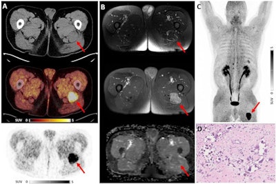 Ga-68 FAPI-PET/CT imaging in a 55-year-old male patient. No increased pulmonary tracer uptake was found (A, C). Tracer uptake colocalized with a sharply circumscribed, inhomogeneously contrast-enhancing mass on MRI without relevant diffusion restriction (B). Pathologic assessment diagnosed a tenosynovial giant cell tumor (D). Image courtesy of the Journal of Nuclear Medicine.