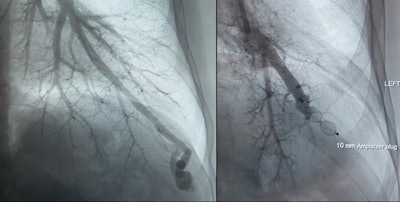 In this HHT patient treated at the Mercy University Hospital, a pulmonary AVM was diagnosed on angiography. Left image: before embolization procedure. Right image: after embolization.