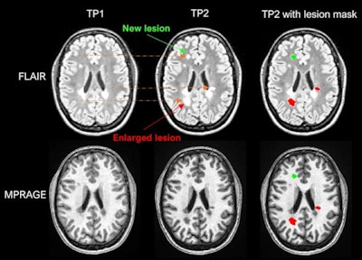 Example of LeMan-PV detecting new and enlarged lesions. The arrows in orange represented in the FLAIR image indicate the region of change from time point 1 (TP1) to time point 2 (TP2) for a new (green arrow) or enlarged (red arrow) lesion. The last column ('TP2 with lesion mask') represents the LeMan-PV progression map overlapping the FLAIR and MPRAGE in TP2. Figure courtesy of Dr. Alexandra Ramona Todea, Lester Melie-Garcia, PhD, et al and JMRI.