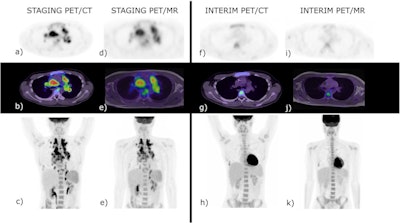 A 20-year-old male with biopsy-proven classical Hodgkin lymphoma, stage IVB. Baseline PET/ CT (a-c) and baseline PET/MR (d-e). At interim restaging PET/CT (f–h) and PET/MR (i-k), there was a concordant complete metabolic response, Deauville 2. The end of treatment study is not shown as there remained complete metabolic response. Incidental right-sided rib fractures persisted between staging and interim studies. SUV scale set between 0-8. Image courtesy of Cancer Imaging through CC BY 4.0.