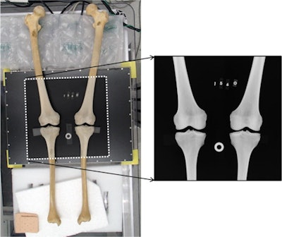 An illustration of the x-ray procedure. The femora and tibiae of each skeleton were fixed on a board with a digital detector attached to it. Then, the tibiofemoral joint was reconstructed and placed in the center of the detector in a standard anatomical anteroposterior position. Sheets of styrofoam and bubble wrap were used to help adjust positioning. Finally, a 30-mm calibration disc and identification number of the specimen were placed onto the detector plate, and the radiograph was obtained. Radiographs were used instead of ordinary photographs as they were considered to capture both external and internal features of bone. Image courtesy of Legal Medicine through CC BY 4.0.