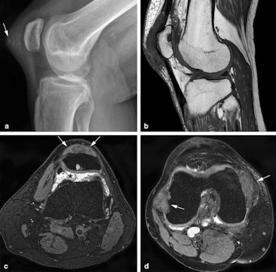 55-year-old man with differential diagnosis of gout in the knee. (A) Lateral radiograph demonstrates marked pre-patellar soft-tissue swelling containing increased density and several ill-defined calcifications (arrow). (B) Sagittal T1 shows a prepatellar, low signal intensity oval-shaped soft tissue mass and a subchondral cyst in the patella. (C) Axial T2-weighted fat-suppressed MRI confirms the prepatellar, low signal intensity mass invading the quadriceps tendon (arrows) and shows joint effusion containing multiple small synovial proliferations in the suprapatellar recess (asterisk). Aspiration of joint fluid with crystals confirmed the diagnosis of gout. (D) Axial T2-weighted fat-suppressed MRI demonstrates low signal intensity soft tissue lesions in keeping with gout tophi deep to the collateral ligaments, causing erosion of the medial and lateral femoral condyles (arrows).