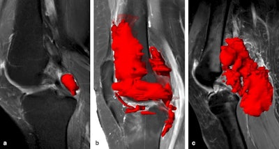 Examples of volumetric segmentation in three different patients. Volumetric segmentations of D-TGCT performed with Brainlab software on sagittal T1 SPIR-weighted sequences post gadolinium. (A) tumor is segmented in the posterior cruciate ligament (PCL) recess (volume shown in red). Volume = 3.8 cm3. (B) Tumor segmentation in anterior, middle, and posterior compartments. Volume = 86.2 cm3. (C) Tumor segmentation of a case with marked posterior disease, present in the PCL recess, subgastrocnemius synovial recesses, Baker's cyst, and extending extra-articular in the popliteal fossa. Volume = 91.9 cm3. Figures courtesy of Dr. Geert Spierenburg, Dr. Kirsten van Langevelde, et al and Insights into Imaging.