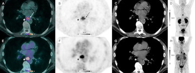 Ga-68 NODAGA-RGD-PET/CT (A), PET (B, D) and CT (C) and F-18 FDG-PET/CT (E), PET (F, H) and CT (G) axial views of a primary lesion (asterisks) in a 53-year-old participant with esophageal squamous cell carcinoma. Note intense homogenous uptake in the primary lesion on F-18 FDG-PET/CT (SUVmax 12.1 g/mL, metabolic tumor volume 2.54 cm3), whereas the primary lesion demonstrates a different uptake pattern in the corresponding Ga-68 NODAGA-RGD-PET/CT image: a weaker and more heterogeneous uptake (SUVmax 5.1 g/mL), seen mostly in the periphery of the tumor, with a slight extension in perilesional structures (arrows), and a larger metabolic tumor volume (metabolic tumor volume 5.35 cm3). Image courtesy of the European Journal of Hybrid Imaging through CC BY 4.0.