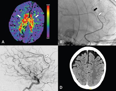 (A-C) Axial perfusion CT (time to maximum, > 6 seconds) at admission shows a bilateral deficit (arrows in A) in the territory of the anterior cerebral artery (ACA; i.e., azygos variant) because of a distal occlusion of the A3 segment (white arrow, sagittal view in B). Stent retriever thrombectomy (black arrow, sagittal view in B) was performed with full reperfusion shown on the final digital subtraction angiography image (arrow, sagittal view in C). (D) Follow-up at 24 hours shows no sign of infarction in the ACA on the axial contrast-unenhanced CT image. Image courtesy of Radiology.