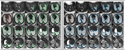 Repeated acquisitions of T2-weighted axial MRI images of the lung in a fetus at gestational week 32. 3D regions of interest (ROIs) encompassing the whole lung were manually segmented in initial (green) and repeat (blue) acquisitions of 30 fetuses. 2D ROIs were defined as lung segmentations at the level of the carina in initial (red) and repeat (orange) acquisitions, respectively. Radiomics feature reproducibility was assessed between features extracted from 2 and 3D ROIs in the initial acquisition (red vs. green), 2D ROIs in repeated acquisitions (red vs. orange), and 3D ROIs in repeated acquisitions (green vs. blue). Figure courtesy of Dr. Martin L. Watzenboeck, Dr. Florian Prayer, et al, and Insights into Imaging.