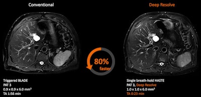 Deep Resolve Boost is now available on several hundred MRI systems, and it will be promoted at ECR 2023, according to Siemens Healthineers.