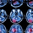2020 07 10 22 42 7022 Stroke Mri 400