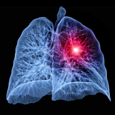 2021 02 02 17 39 1965 Lung Cancer Ct 3d 400