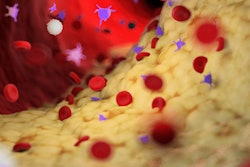 2021 08 17 22 51 4756 Plaque Artery 400