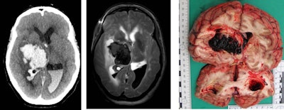 Brain hemorrhage due to hypertension or vessel anomalies is a natural death -- this finding in the postmortem imaging can allow such cases to be closed without open invasive autopsy. Images courtesy of Prof. Michael Thali.