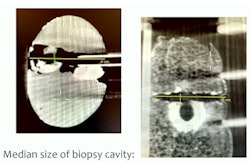2023 03 02 16 22 8490 2023 03 01 Ecr Cbct Breast Biopsy 400