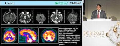 Dr. Nikhil Seniaray of Mahajan Imaging in New Delhi, India, presented a study on 2 March that looked at brain imaging findings in patients with COVID-19.