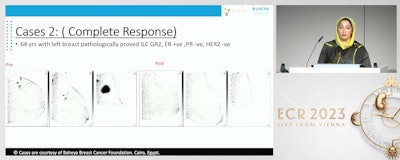 Dr. Yasmin Nada from the Baheya Foundation for Early Detection & Treatment of Breast Cancer in Egypt presents her team's findings at ECR 2023, showing that positron emission mammography (PEM) can successfully evaluate the response of breast cancer to neoadjuvant chemotherapy. Here, PEM shows breast tumors before and after chemotherapy in a 64-year-old woman. PEM showed complete response in this case.