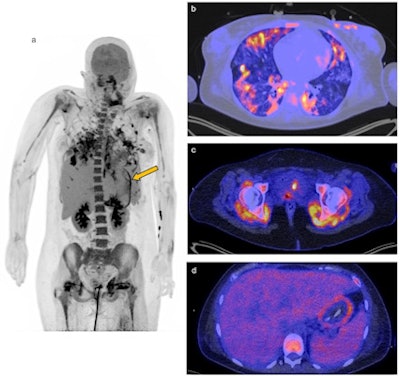 F-18 FDG-PET/CT of a 26-year-old woman with COVID-19. (A) Maximum intensity projection. Physiological uptake in the kidneys and liver. Reduced uptake in the brain due to sedation. Reactive bone marrow. The yellow arrow points toward the uptake in the gastric wall. (B) Transaxial fusion PET/CT image of the lungs with ground-glass opacities and some consolidations on CT, characteristic for COVID-19 acute respiratory distress syndrome (ARDS). Heterogenous uptake of F-18 FDG radiotracer. CT in lung setting. (C) Transaxial fusion PET/CT image of the hips with high uptake in the posterior lateral and medial muscle of the hip at both sides. CT in soft tissue setting. (D) Transaxial fusion PET/CT image of the abdomen with clear tracer uptake in the gastric wall. SUV-bw threshold of 5.00 α = 50%. Image and caption courtesy of Clinical and Translational Imaging through CC BY 4.0.