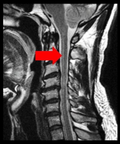 The Gibbs ringing effect. Sagittal T2-weighted image of cervical spine. Parallel bands-like areas of alternating high and low signal intensity occur at sharp transition edges of an object – in this case, the cerebrospinal fluid and the medulla (arrow).