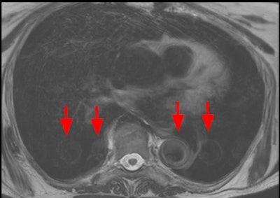 Nonvoluntary movement artifact. Axial turbo spin echo, T2-weighted slice of the thorax with multiple replicas of the aorta (arrows) displayed on the phase-encoding direction, due to the vibration. The best strategy here is to invert phase and frequency directions in case of periodic artifacts. All images courtesy of Dr. Patricia Andrea Gutierrez et al and presented at ECR 2023.