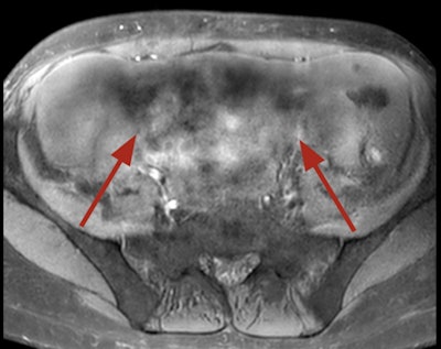 Dielectric artifact. Axial echo gradient fat-saturated T1-weighted slice of the abdomen acquired on a 3-tesla device, showing multiple blurred areas of signal loss (arrows) at distance of the receiving coil, in a patient with abundant ascites. The strategy in this case would be first to apply parallel radiofrequency transmission technique, and if insufficient, to rescan the patient on a 1.5-tesla scanner.