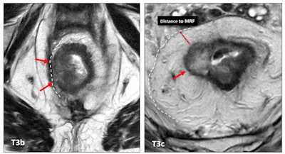 The treatment of a patient with rectal cancer mainly depends on the TNM (tumor, node, metastasis) stage and whether the mesorectal fascia (MRF) is involved. A T3b stage rectal tumor with MRF involvement (left, red arrows) compared to a T3c tumor with free MRF (right, red arrow). MRF involvement clearly worsens the prognosis of the tumor with a lower category of T staging. All images courtesy of Dr. María Canedo Antelo et al and presented at ECR 2023.