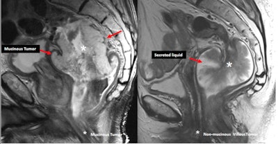 Mucinous tumors contain more than 50% of stromal mucin (left, sagittal T2-weighted MR image shows high signal intensity within the tumor). They must not be confused with non-mucinous lesions that secrete a large amount of liquid into the lumen (right).