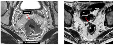 Serosal involvement does not necessarily represent peritoneal carcinomatosis. In peritonealized portions of the rectum (proximal), tumor can be staged as T4a and does not represent carcinomatosis. These tumors have a significantly higher risk of carcinomatosis (M1c stage). This group of patients might be eligible for new treatment strategies that aim to treat in an earlier or even preventive setting. (PR = peritoneal reflection)