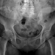 2023 03 27 22 22 2168 2023 03 24 Pelvis X Ray 20230327223906