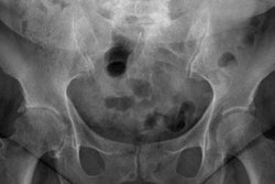 2023 03 27 22 22 2168 2023 03 24 Pelvis X Ray 20230327223906