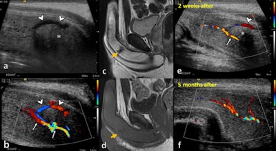 A 37-year-old man presented after a crush injury to the perineum with swelling and high-flow priapism. On ultrasound in a sagittal plane of the right cavernosal body at the base of the penis (a-b), there is an abnormal communication between the right cavernosal artery (thin arrows) and a prominent draining vein (arrowheads) consisting of an arteriovenous fistula. There is an associated cavernosal hematoma (asterisk). Two weeks later, an MRI scan without contrast was performed, showing an area of hypointensity both on T2-weighted imaging (c) and T1-weighted imaging (d) compatible with a late subacute-chronic hematoma. The arteriovenous fistula was embolized with Gelfoam (not shown). A follow-up ultrasound was performed two weeks later (e). It demonstrates persistence of the fistula, but with a decrease in the size of the hematoma (asterisk) and a reduction in the calibre and peak systolic velocity of the right cavernous artery (thin arrow). Five months later (f), the cavernosal hematoma and arteriovenous fistula had disappeared. All images courtesy of Dr. Miguel Ángel Gómez-Bermejo, Dr. Dean Huang, and Prof. Paul Sidhu.