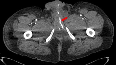 CT scan shows a traumatic arteriolacunar fistula, with the left cavernous sinus exhibiting early enhancement (indicated by red arrow) compared to the right.